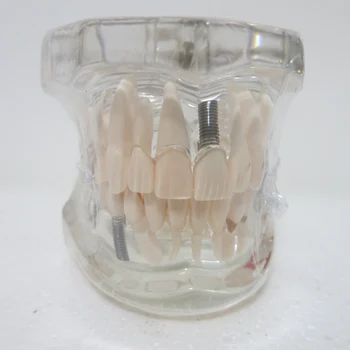 Zobozdravstveni materiali Ustni izmenljive zobni patološkega model Posebno dekoracijo Kliniki osebno dekorativne Figurice